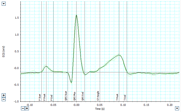 ECG Analysis